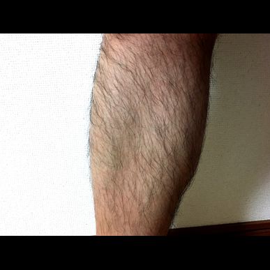 すね毛の脱毛をしたいとお考えでしたらATTENDへお越しください